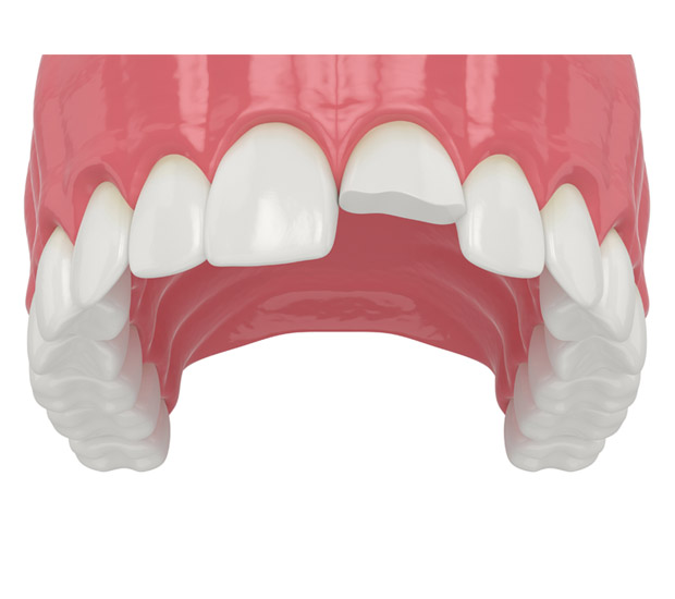 Brandon What Should I Do If I Chip My Tooth