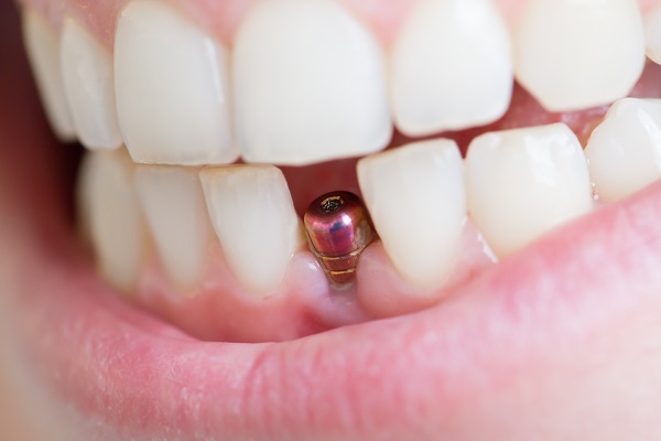 Dental Implants Brandon, MS