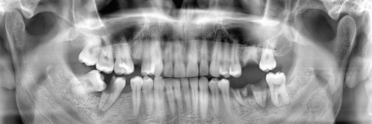 Brandon Options for Replacing Missing Teeth