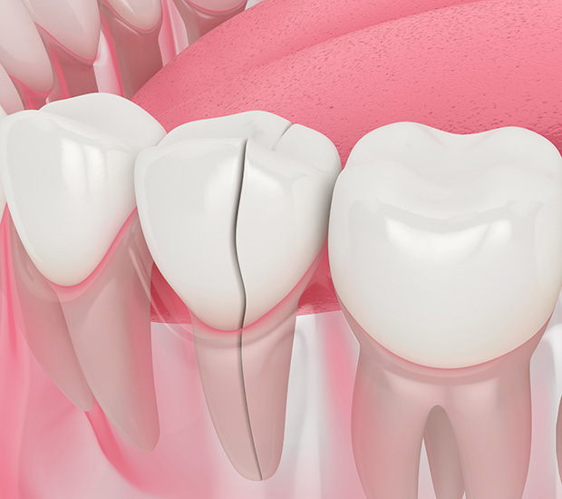 Brandon Types of Dental Root Fractures